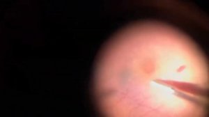 Macular hole surgery with Autologous Platelet Rich Plasma (PRP), Part 1