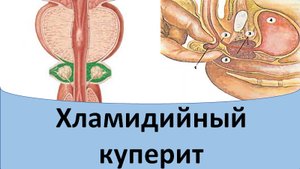 Хламидиоз куперовых желез.