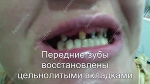 металлокерамические протезы 1