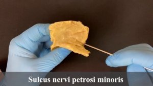 Височная кость (превью) - Os temporale (анатомия человека)