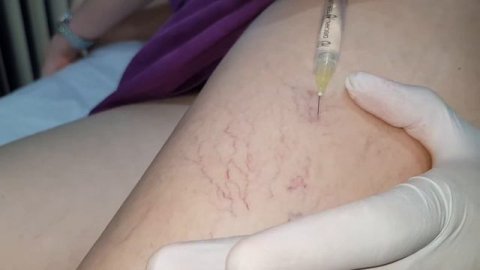 склеротерапия склеротерапия противопоказания как убрать пятна после склеротерапии синяки после цена