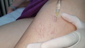 склеротерапия склеротерапия противопоказания как убрать пятна после склеротерапии синяки после цена