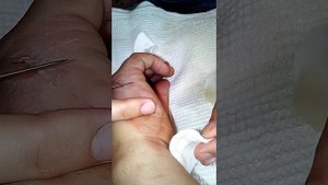 Прыщ водянка после ожога!