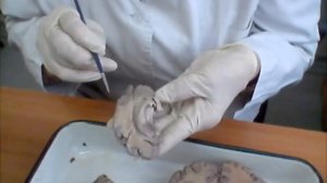 Боковые желудочки головного мозга