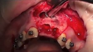 Удаление слизистой гайморовых пазух.