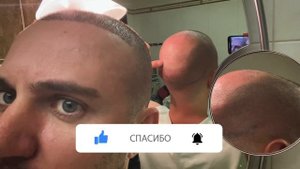 Личный опыт и советы: Как долго заживают раны после пересадки волос / Красавчик