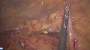 Лапароскопическая передняя резекция прямой кишки. Оперирует Илья Леонидович Черниковский.