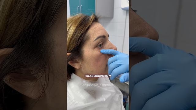 Как вам результат?😱 Коронарная подтяжка лба. Нижняя блефаропластика. НИКОЛАЕВА САНДАРА АФАНАСЬЕВНА