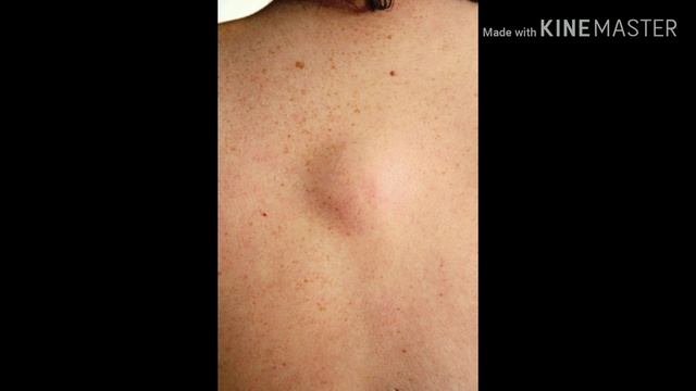 как избавиться от жировика смотреть онлайн