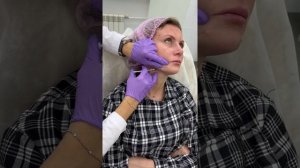 BioHyalux Mevita C - Азиатский протокол введения BV5