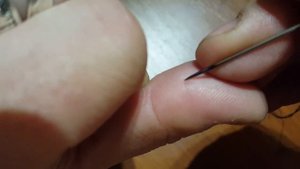 Как вытащить занозу самому в домашних условиях?