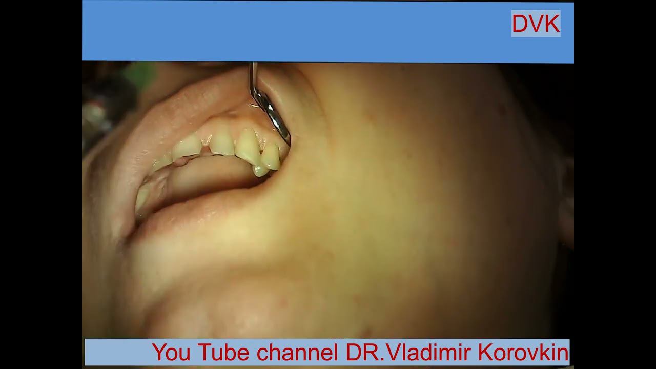 Infiltration anesthesia for treatment 24,35 teeth.#nerveblock #localanaesthesia