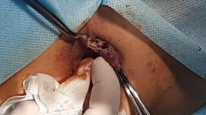 Геморроидэктомия