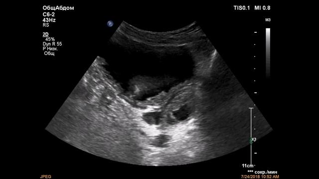 Инфравезикальная обструкция смотреть онлайн