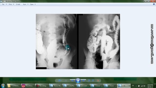 شرح أشعة الجهاز الهضمي والمسالك البولية GIT & Urology د. محمود سويلم смотреть онлайн