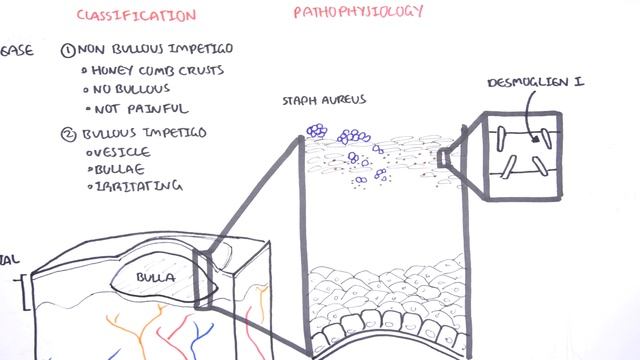 Impetigo Bacterial Skin Infection - Overview (Clinical Presentation, Pathophysiology, Treatment) смотреть онлайн