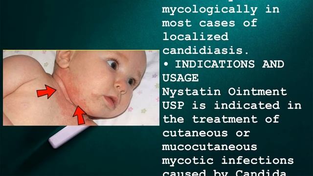Nystatin 100,000 Ointment смотреть онлайн