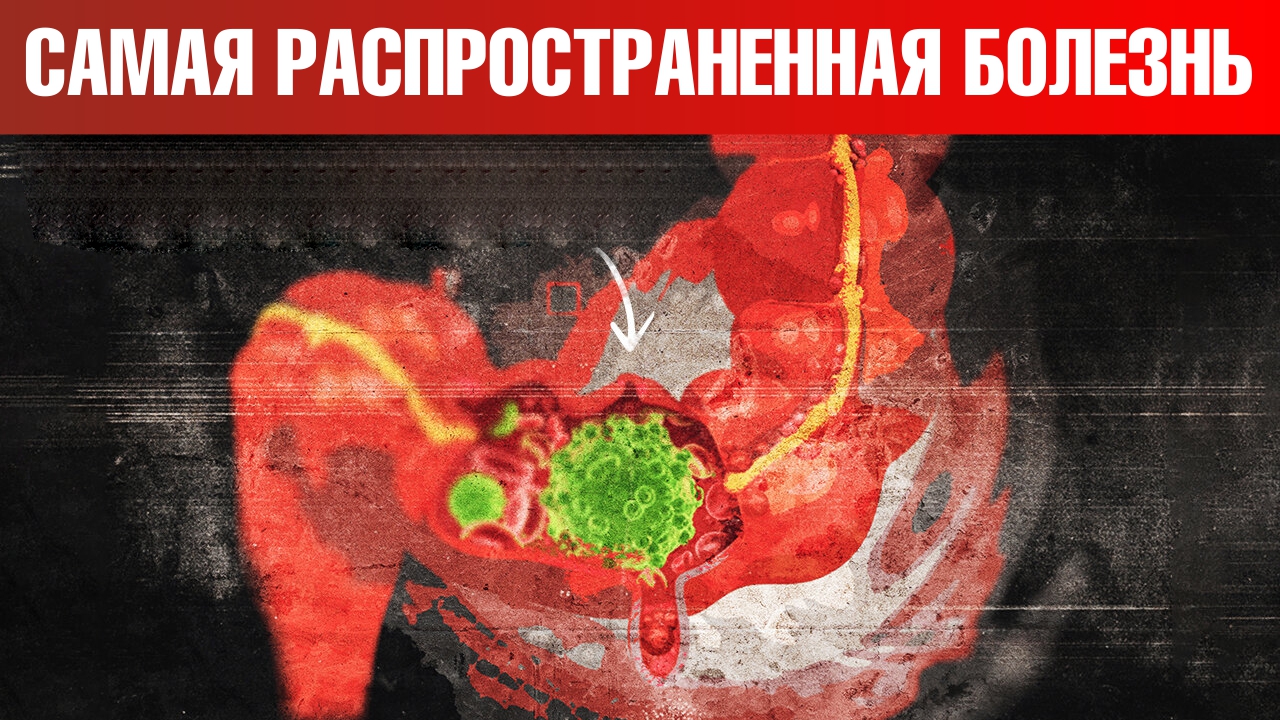 Эпидемия аутоиммунных заболеваний. Как себя обезопасить?🤔