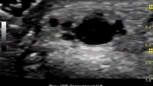 Лучевая артерия после коронарографии