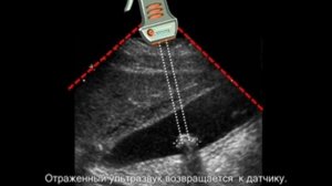 Камень в желчном пузыре на УЗИ