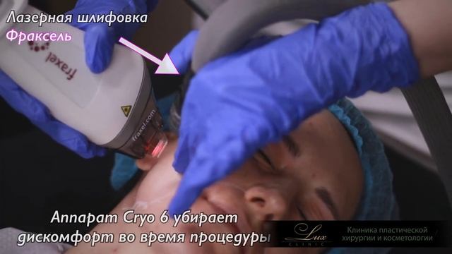 Лазерное омоложение Фраксель (Fraxel) в LuxClinic смотреть онлайн