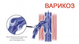 Варикоз / Доктор Черепанов