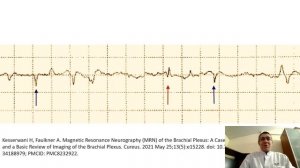 Синдром Персонейджа-Тернера