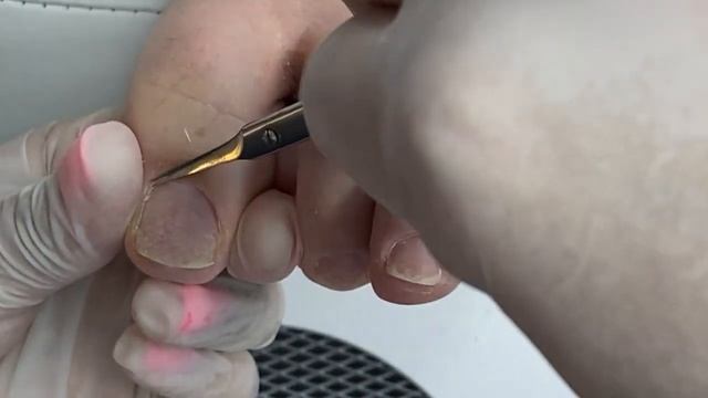 Растяжка блестками и пастель, сухой птеригий смотреть онлайн