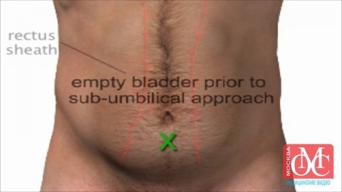 парацентез