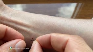 Укусил Клещ Что Делать. Как Вытащить Клеща Ниткой