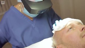 Пересадка волос методом HFE