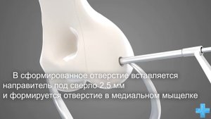 Фиксация неполного внутрисуставного перелома латерального мыщелка плечевой кости