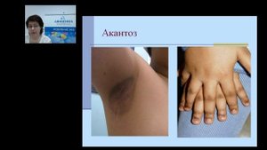 Ожирение у детей и подростков