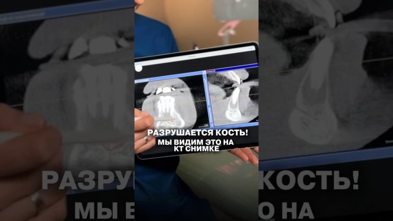Удаление не выход ♀️ Лечение зуба с помощью апикальной микрохирургии. #стоматология #dentist