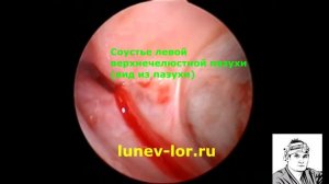 Как работает соустье верхнечелюстной пазухи 22032018 С