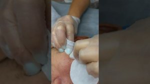 Механическая чистка лица