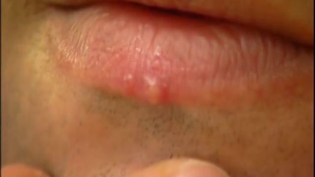 Простуда на губах! Узнаем, быстрый способ борьбы с герпесом! смотреть онлайн