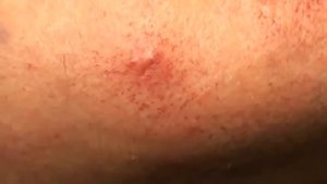 Правильное выдавливание прыщей и угрей