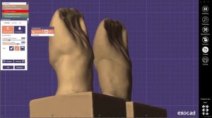 EXOCAD Carving "0 11-2"