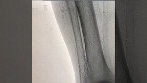 Ангиопластика и стентирование артерий нижних конечностей