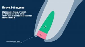 Заживление лунки зуба после удаления