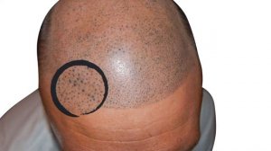 "Unveiling the Unique Features of the Weston System - Scalp Micropigmentation (SMP) Insights"