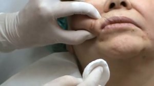 Princess, канюли, обучение контурной пластике, демо, 111013 1