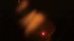 Периферическая лазерная коагуляция сетчатки