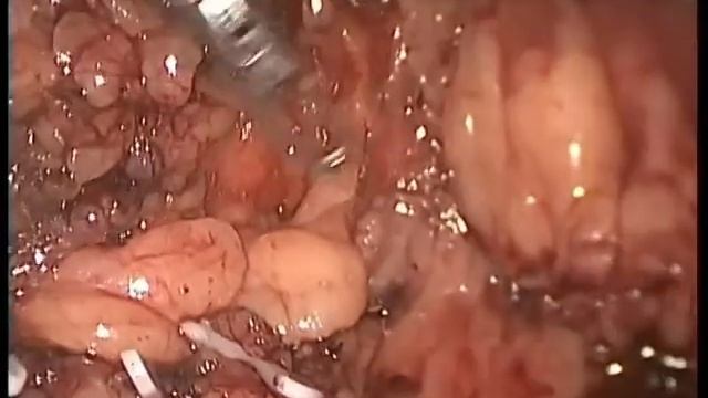 Видеолапароскопическая резекция сигмовидной кишки по поводу стенозирующего полипа смотреть онлайн