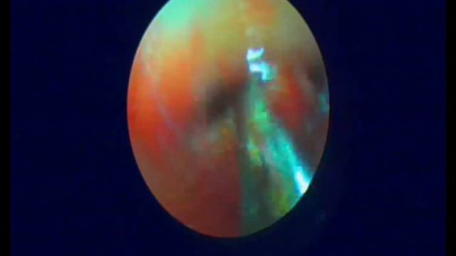 Гистероскопия в Самарканде. Удаление инородного тела из полости матки ВМС смотреть онлайн