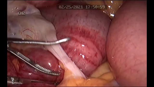 Лапароскопия рассечение спаек при странгуляционной кишечной непроходимости смотреть онлайн