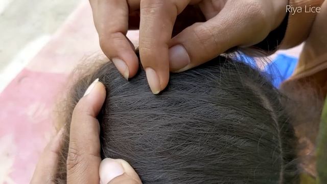 Getting out all most of lice from brown hair - How to remove lice from her head смотреть онлайн