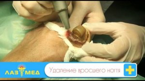 Удаление вросшего ногтя
