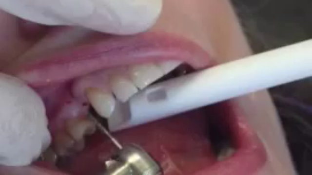 Bradford Frank Dentist Ashland oregon showing off a drill extender during a dental procedure